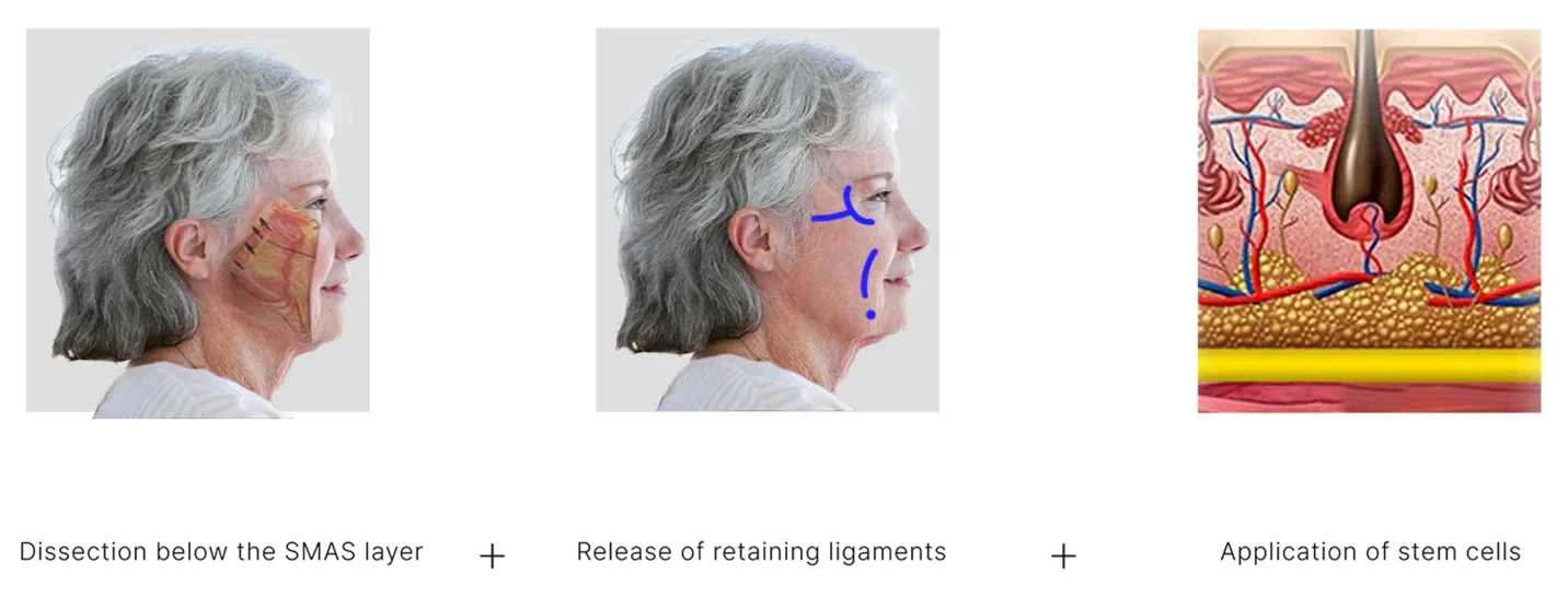 Principle of the SVF deep plane facelift - sub-SMAS dissection, release of retaining ligament tissue, SVF application - TheLINE Plastic Surgery