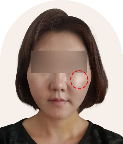 2030 미니 동안 거상 수술 1주 후 정면 - 더라인성형외과