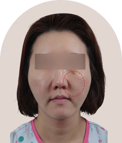 2030 미니 동안 거상 수술 전 정면 - 더라인성형외과