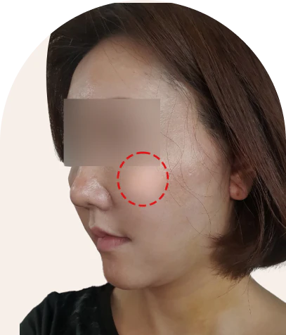 2030 미니 동안 거상 수술 1주 후 45도 - 더라인성형외과