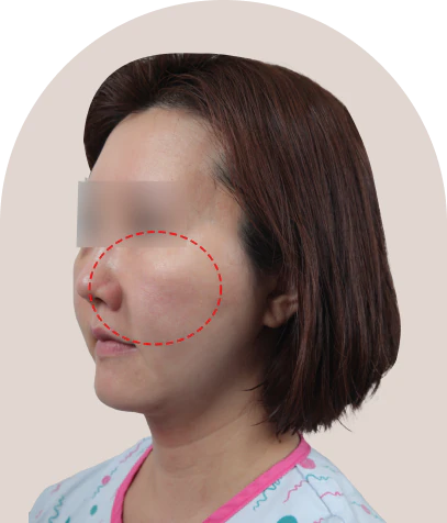 2030 미니 동안 거상 수술 전 45도 - 더라인성형외과