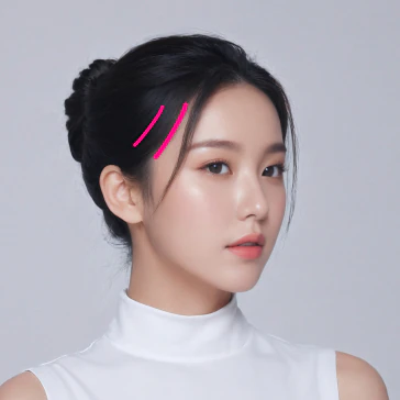 2030 미니 동안 거상 측두 미세 절개 위치 - 더라인성형외과