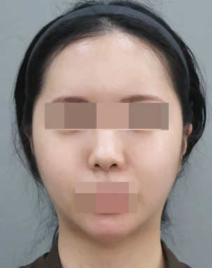 SVF 얼굴 지방이식 2개월 후 정면 - 더라인성형외과