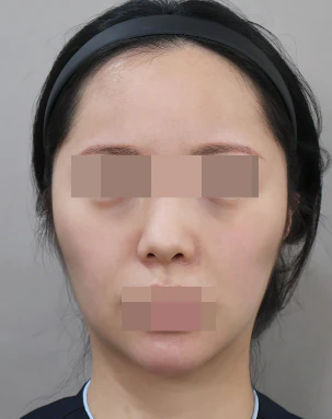 SVF 얼굴 지방이식 수술 전 정면 - 더라인성형외과
