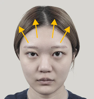 이마거상 맞춤형 리프팅 방향 설정 - 더라인성형외과