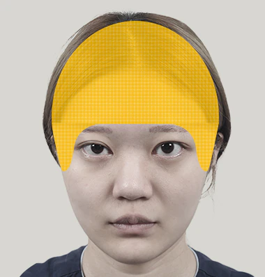 이마거상 조직 박리 범위 - 더라인성형외과