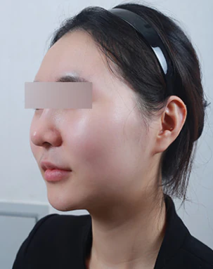 V라인 얼굴 지방흡입 수술 전 45도 - 더라인성형외과