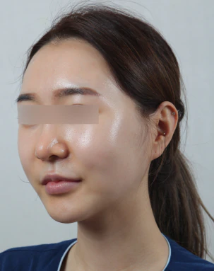 V라인 얼굴 지방흡입 3개월 후 45도 - 더라인성형외과