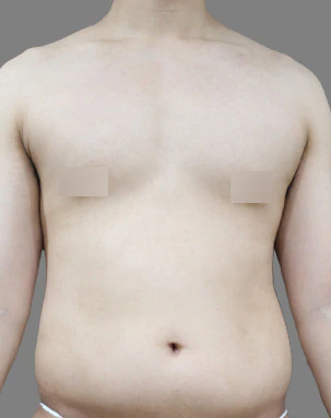 남성 지방흡입 수술 전 정면 - 더라인성형외과