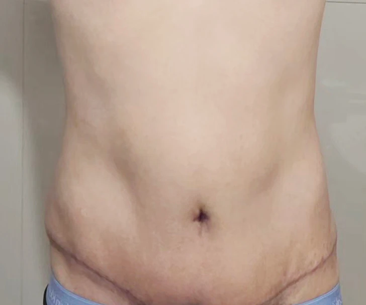 복부거상 후기 적어봅니다. 사진 3