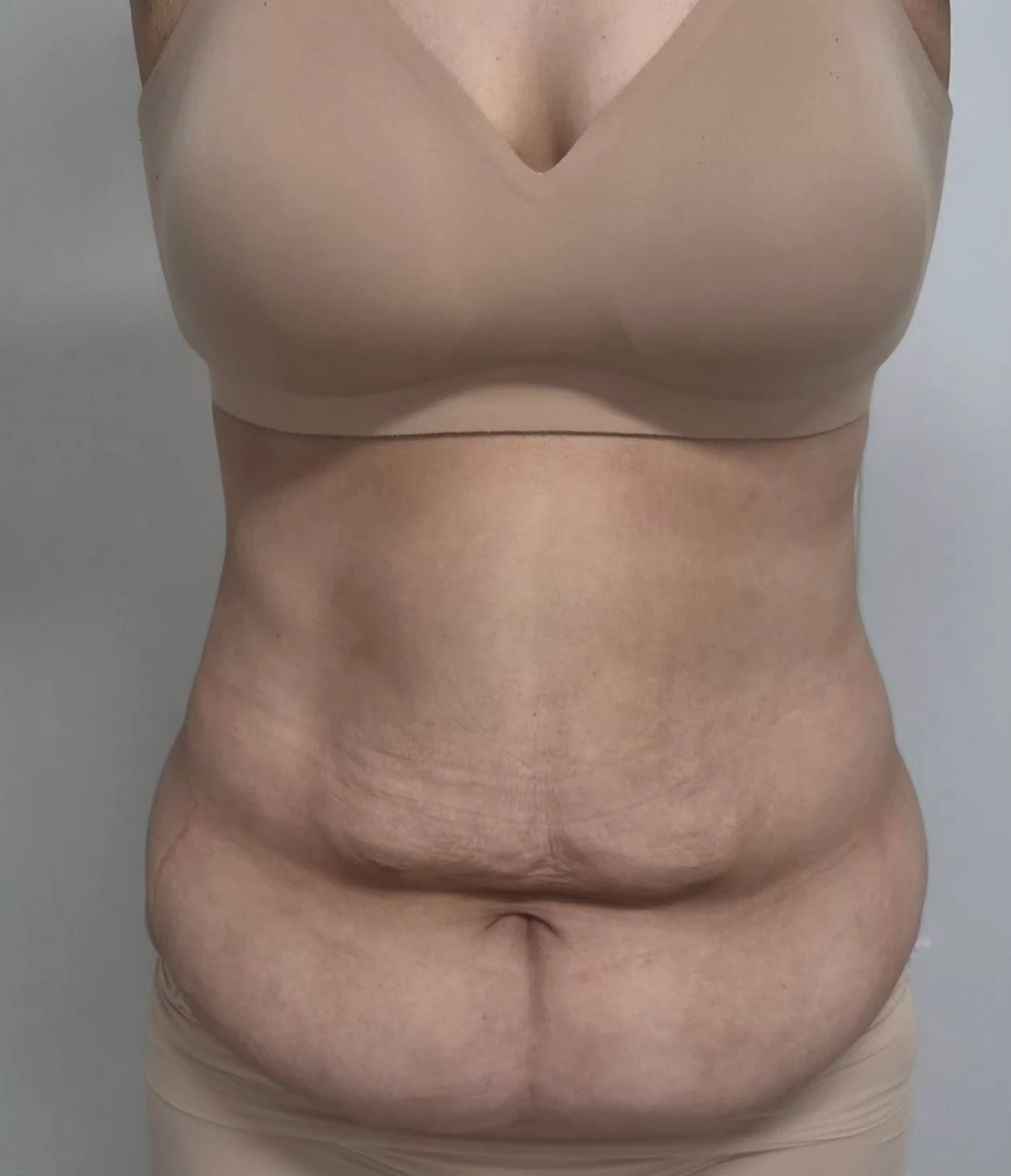 복부거상 3개월차 입니다. 사진 1