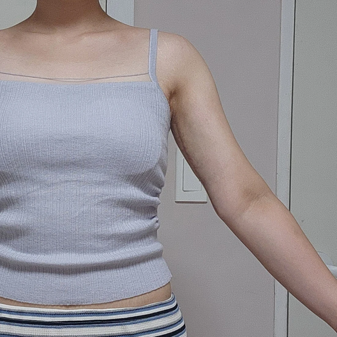 Arm lift, 6 months out (Dr. Cho) - Body Contouring After 4 - TheLINE Plastic Surgery