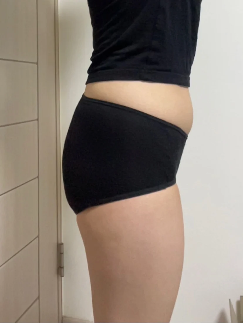 Posting my hip grafting review - Thigh Liposuction (Lower Body) Before 2 - TheLINE Plastic Surgery