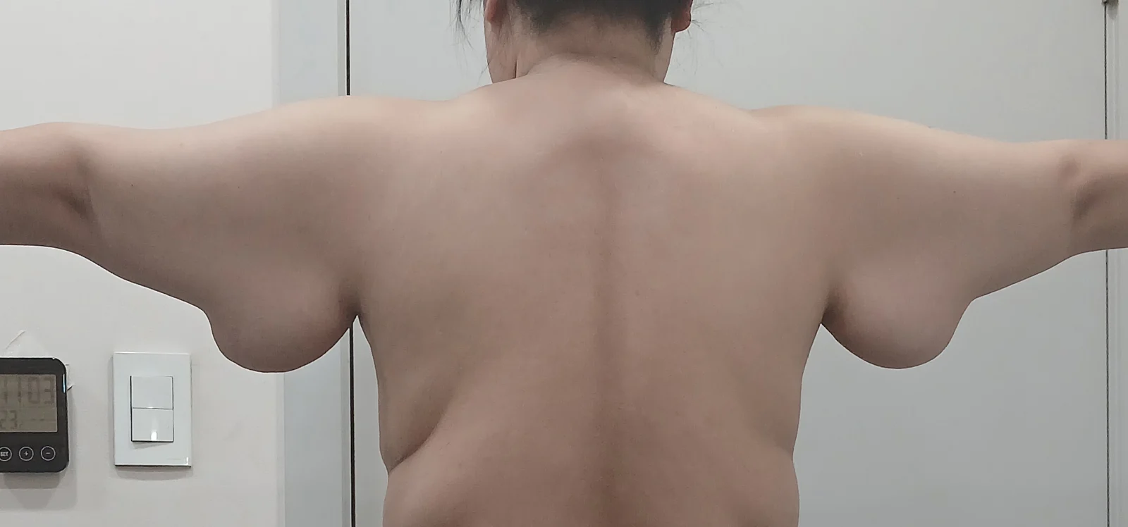 I had arm and axillary breast liposuctio - Body Contouring Before 2 - TheLINE Plastic Surgery