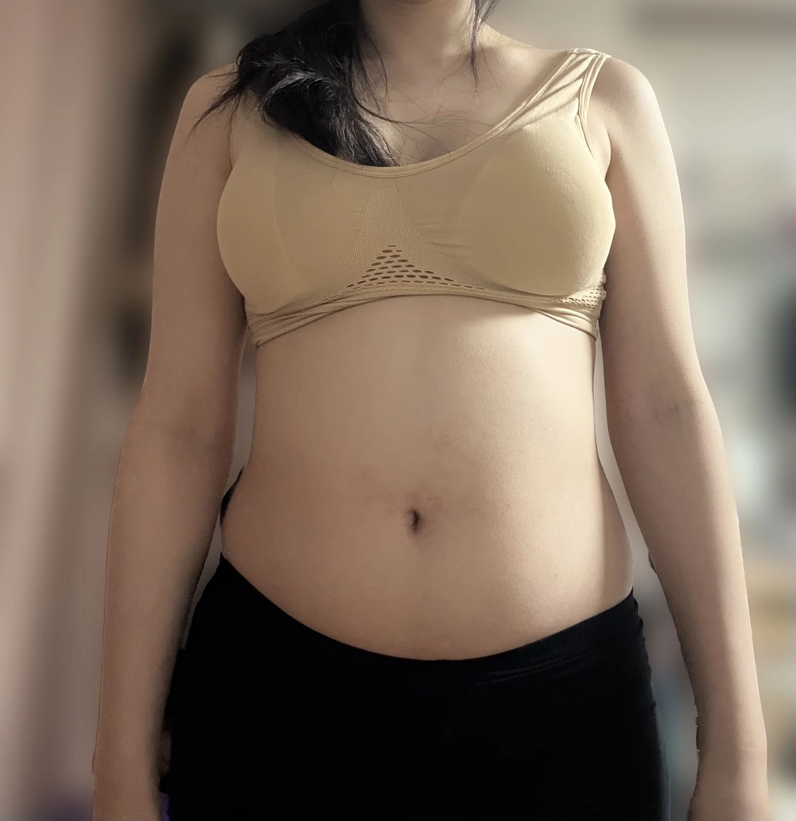 I had arm and abdomen liposuction~~ - Arm Liposuction surgery Before photo - TheLINE Plastic Surgery
