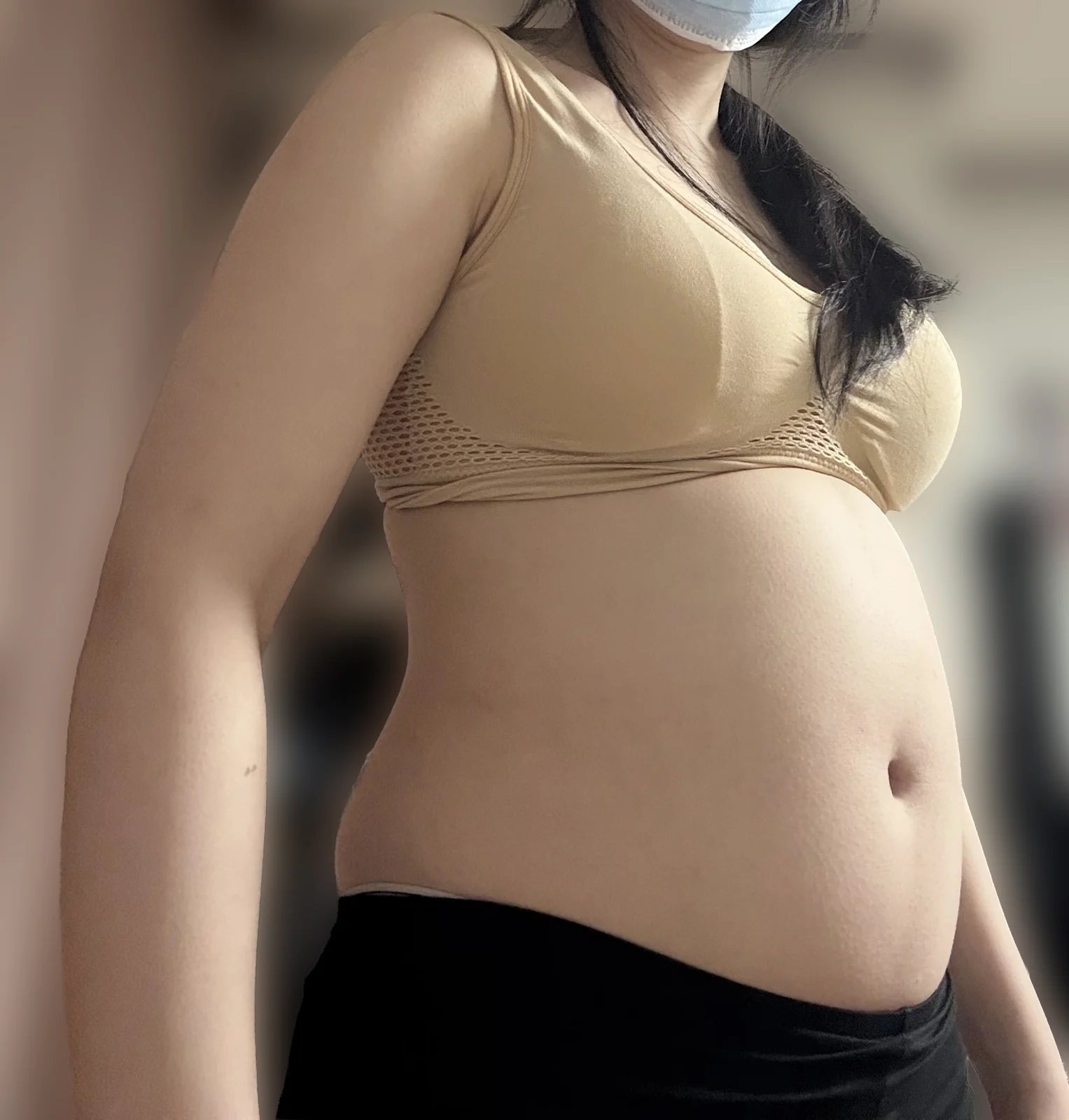 I had arm and abdomen liposuction~~ - Arm Liposuction Before 2 - TheLINE Plastic Surgery
