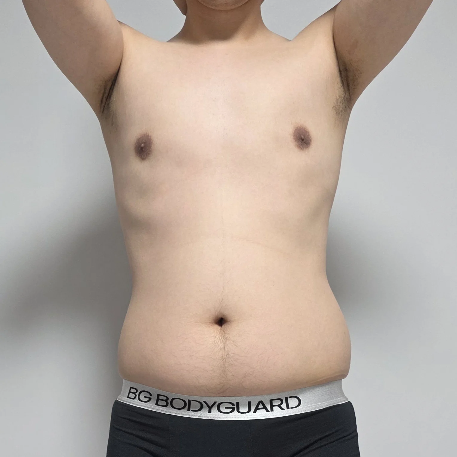 My abdomen and flank liposuction review - Abdominal Liposuction (Upper Body) Before 2 - TheLINE Plastic Surgery
