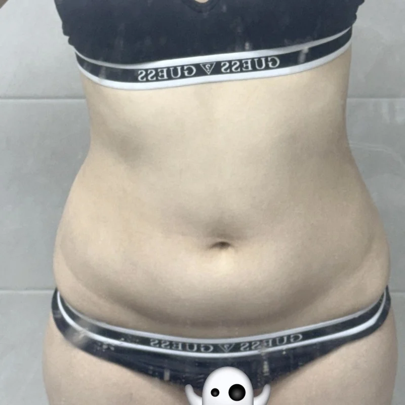 My 3-month review - Breast Fat Grafting Before 2 - TheLINE Plastic Surgery