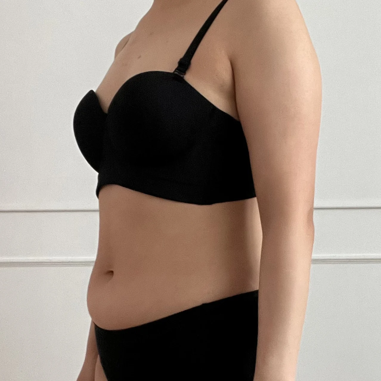 Abdomen and upper arm lipo review at 3 m - Arm Liposuction surgery Before photo - TheLINE Plastic Surgery