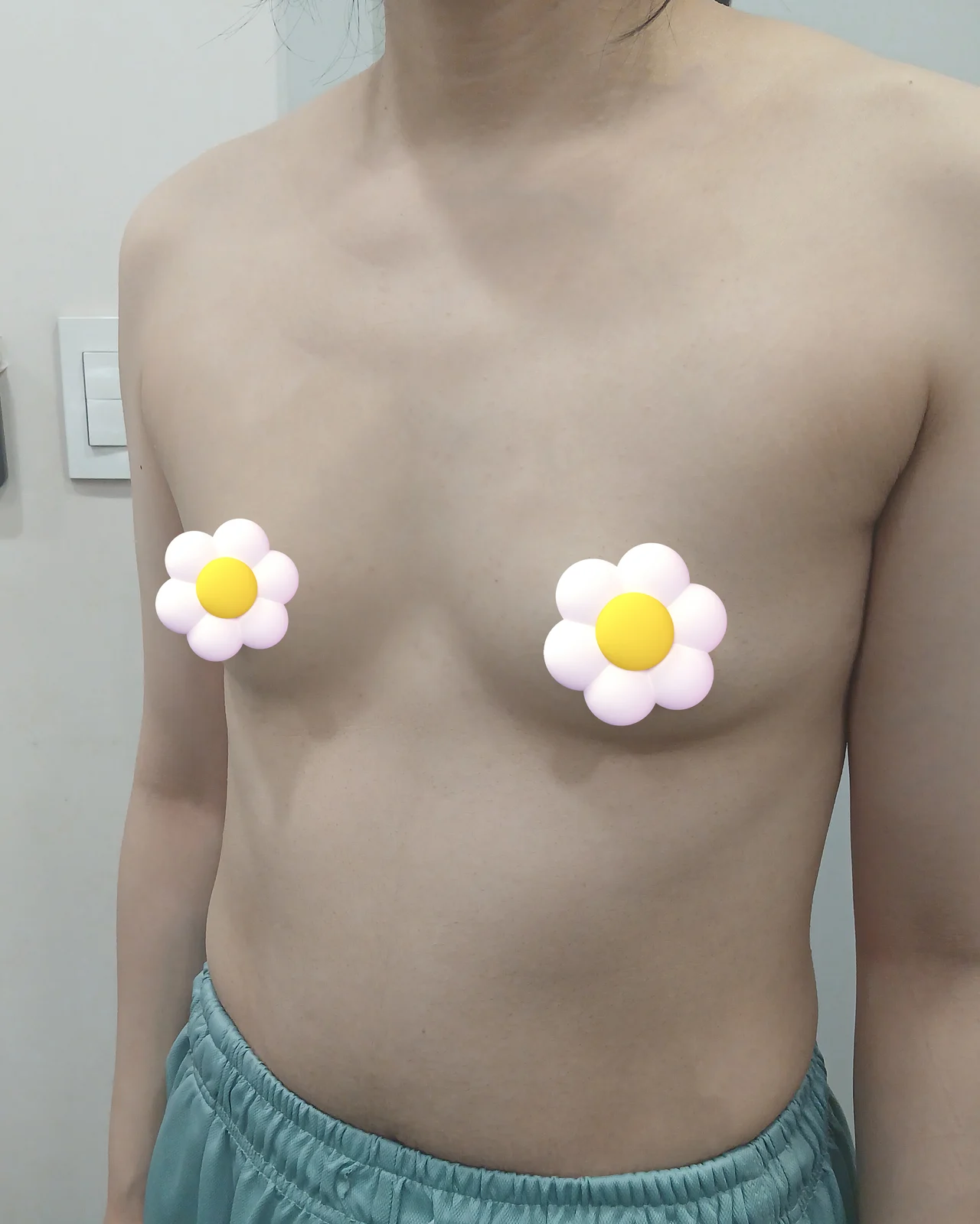 One month after surgery! - Arm Liposuction surgery Before photo - TheLINE Plastic Surgery