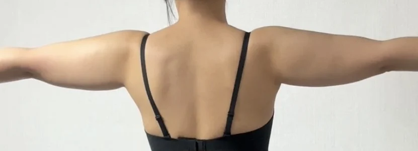 It has been a month since my stem cell a - Arm Liposuction surgery Before photo - TheLINE Plastic Surgery