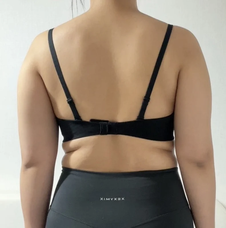 It has been a month since my stem cell a - Arm Liposuction Before 2 - TheLINE Plastic Surgery