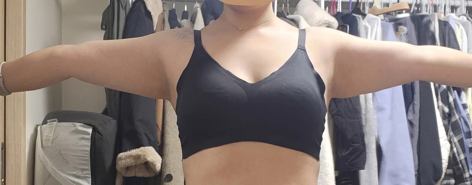 My upper arm liposuction review at 1 mon - Arm Liposuction surgery Before photo - TheLINE Plastic Surgery