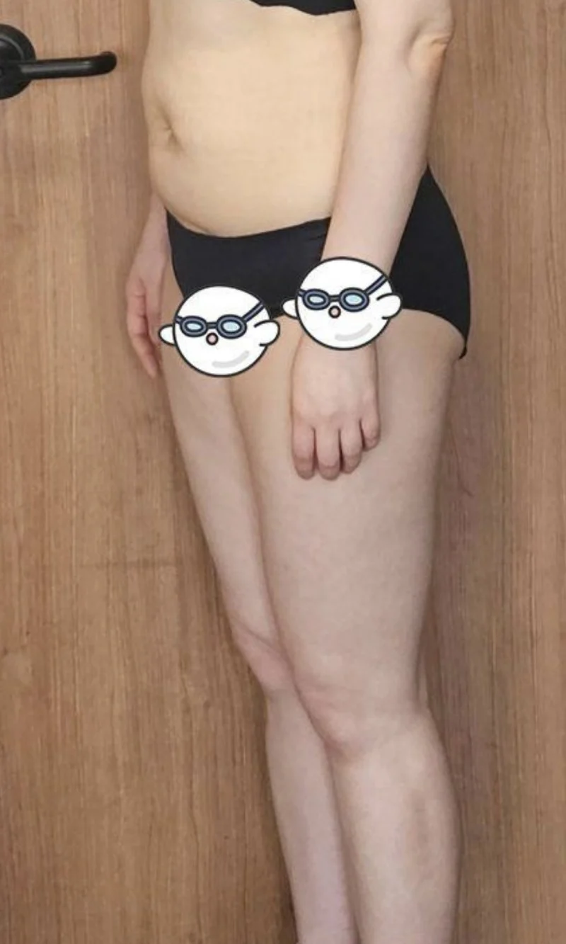 Thank you Dr. Yoosuk Chung and Dr. Jungj - Abdominal Liposuction (Upper Body) Before 2 - TheLINE Plastic Surgery