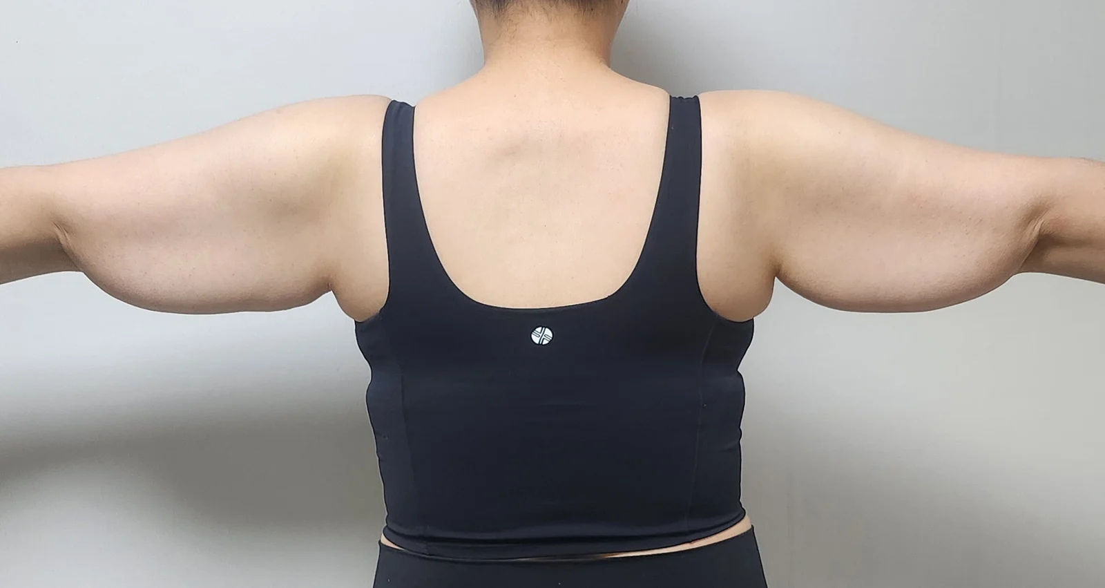 My arm liposuction and arm lift review~ - Body Contouring Before 2 - TheLINE Plastic Surgery