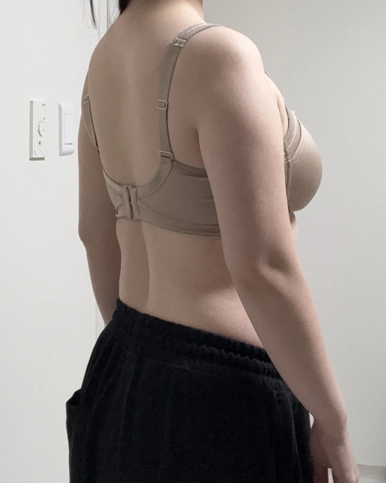 I had arm liposuction - Arm Liposuction Before 2 - TheLINE Plastic Surgery