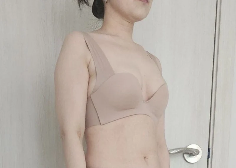 Liposuction and arm lift surgery - Body Contouring Before 2 - TheLINE Plastic Surgery