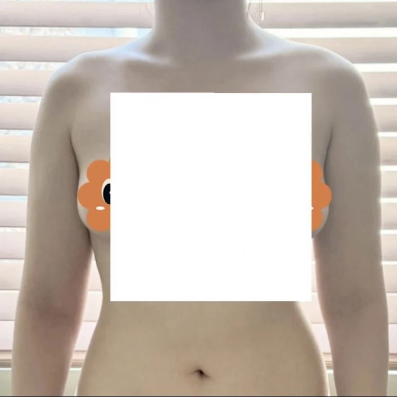 I regret not doing it sooner - Arm Liposuction Before 2 - TheLINE Plastic Surgery