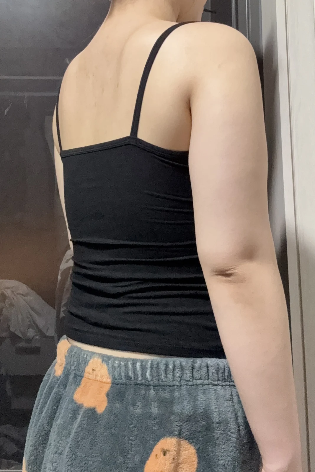 It's been 3 months since my arm and acce - Arm Liposuction Before 2 - TheLINE Plastic Surgery
