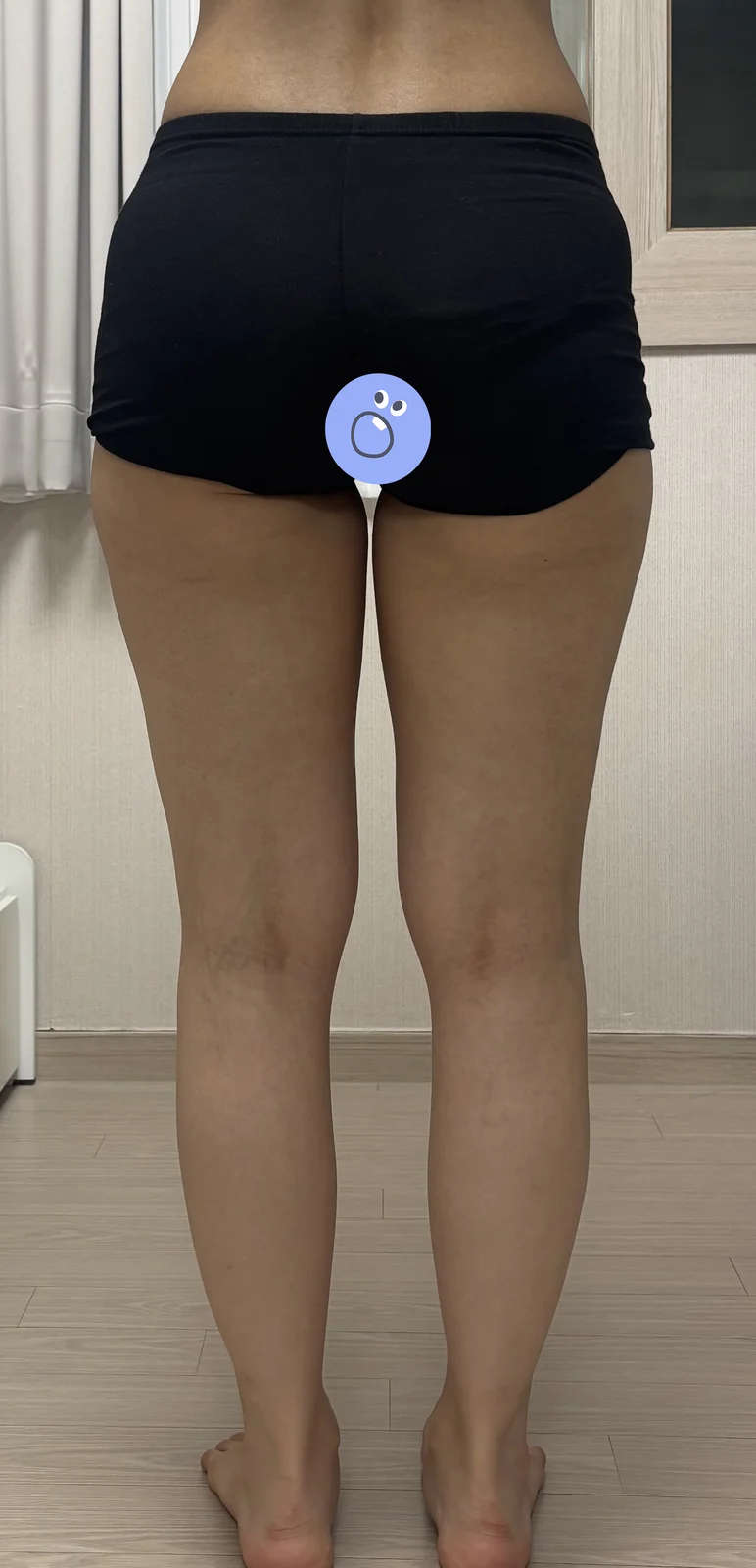 It's been 3 months since my inner thigh  - Thigh Liposuction (Lower Body) Before 2 - TheLINE Plastic Surgery