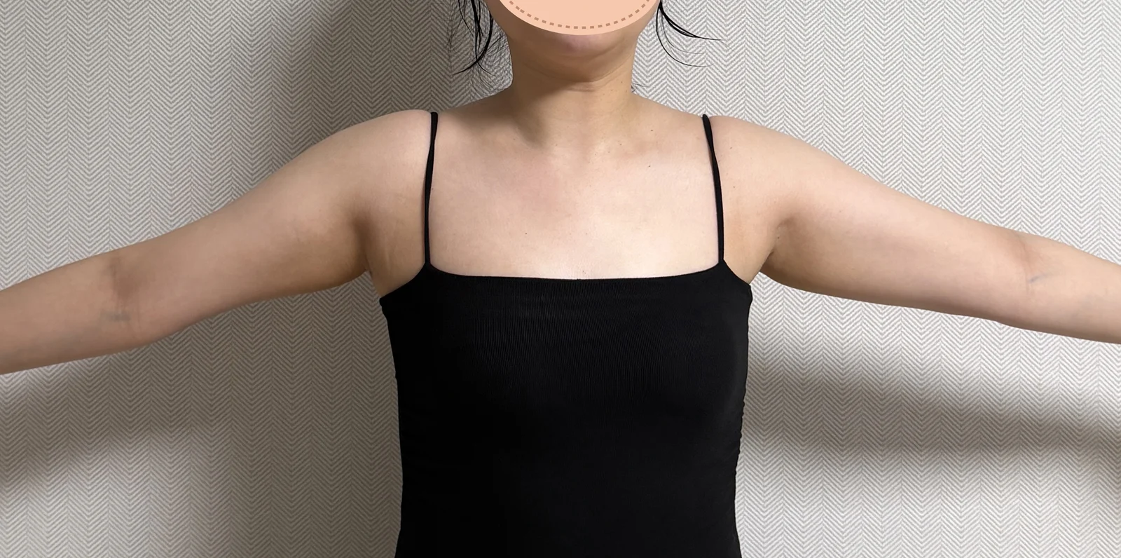 My upper arm stress is gone T_T - Arm Liposuction Before 2 - TheLINE Plastic Surgery