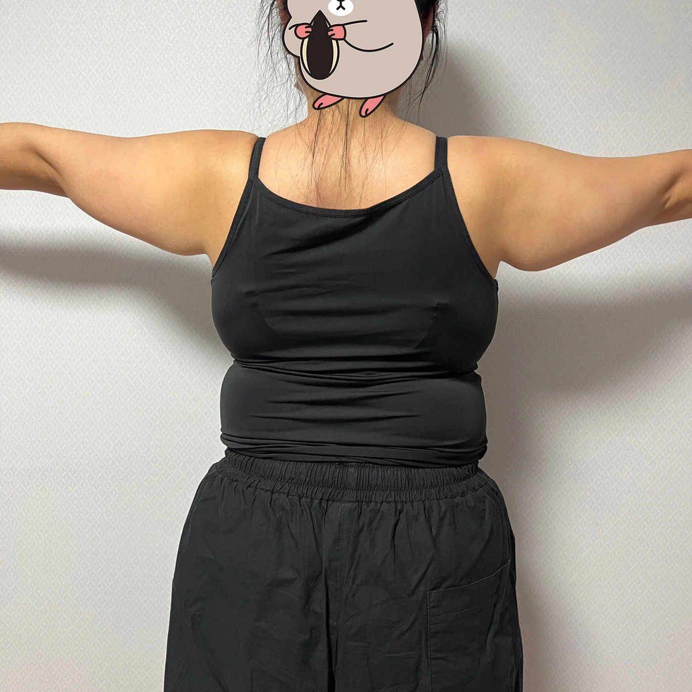 3-month review of arm lipo and arm lift - Body Contouring Before 2 - TheLINE Plastic Surgery