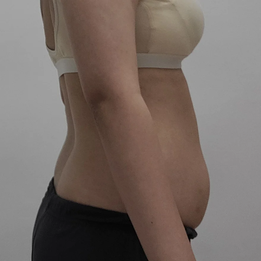 TheLINE Plastic Surgery abdomen and love - Abdominal Liposuction (Upper Body) Before 2 - TheLINE Plastic Surgery
