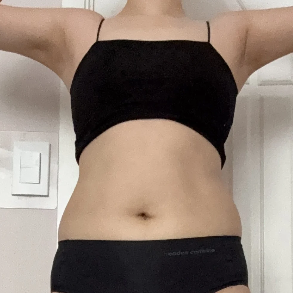 Abdomen and love handle liposuction revi - Abdominal Liposuction (Upper Body) Before 2 - TheLINE Plastic Surgery