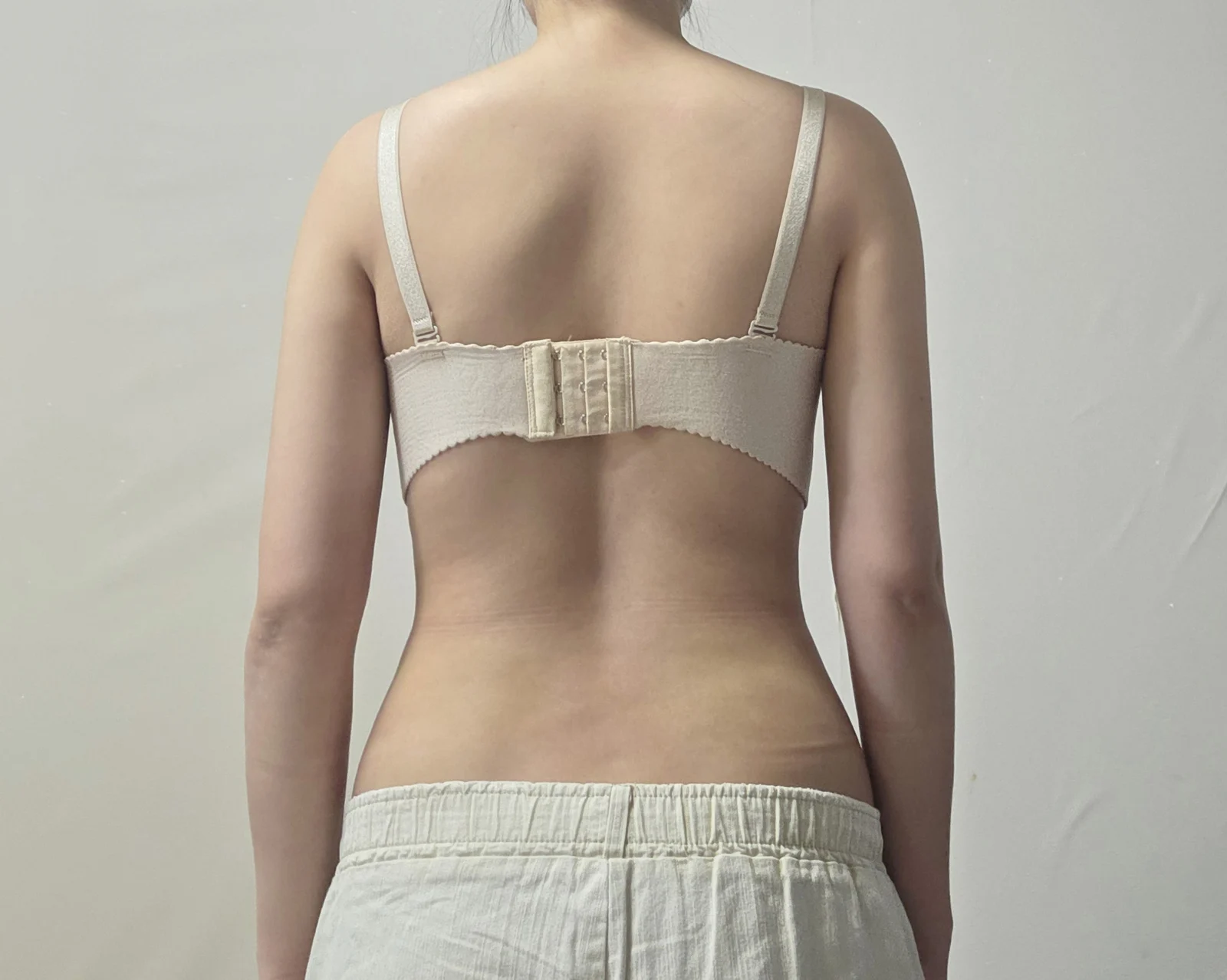 Exactly one month since my arm liposucti - Arm Liposuction After 4 - TheLINE Plastic Surgery