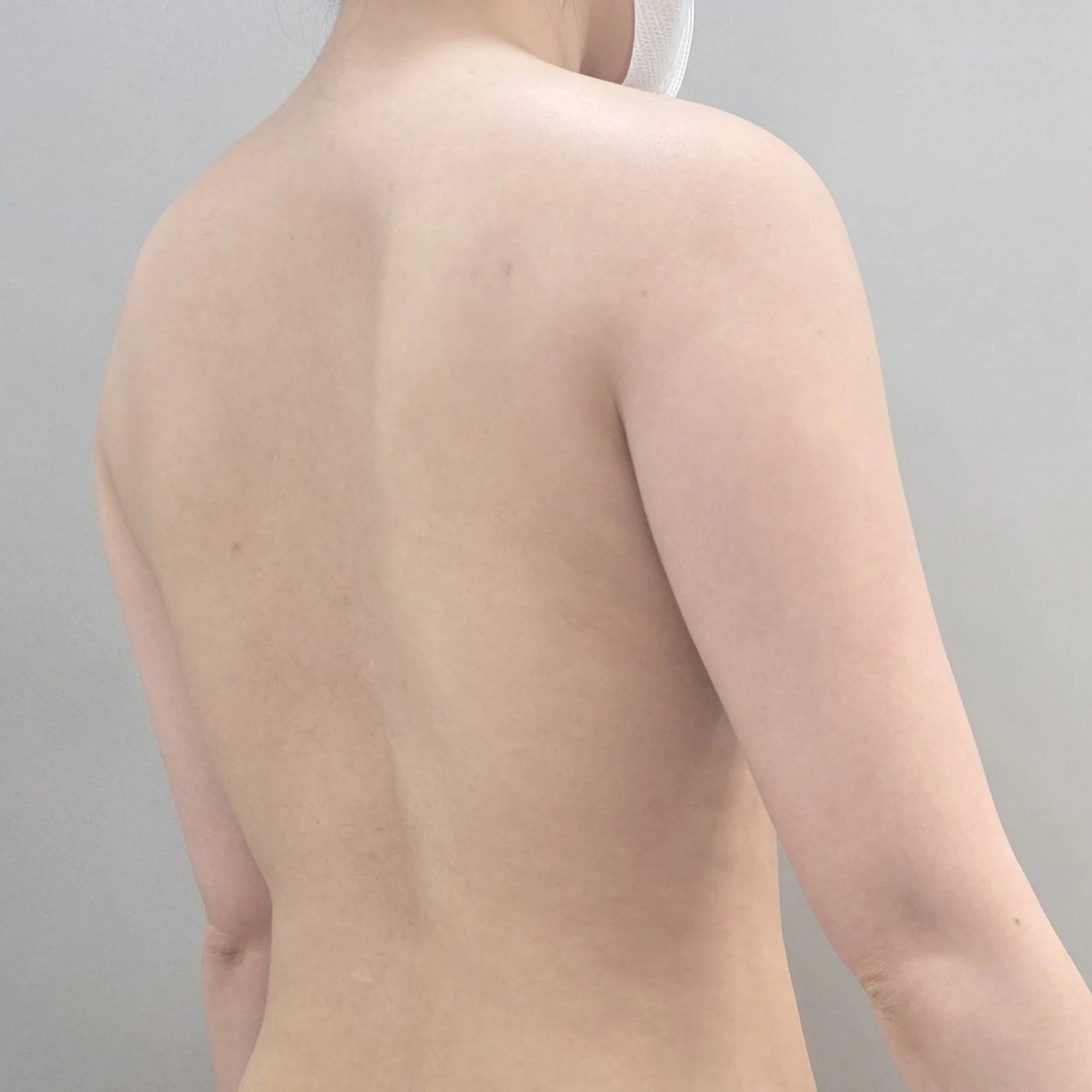 Exactly one month since my arm liposucti - Arm Liposuction surgery Before photo - TheLINE Plastic Surgery