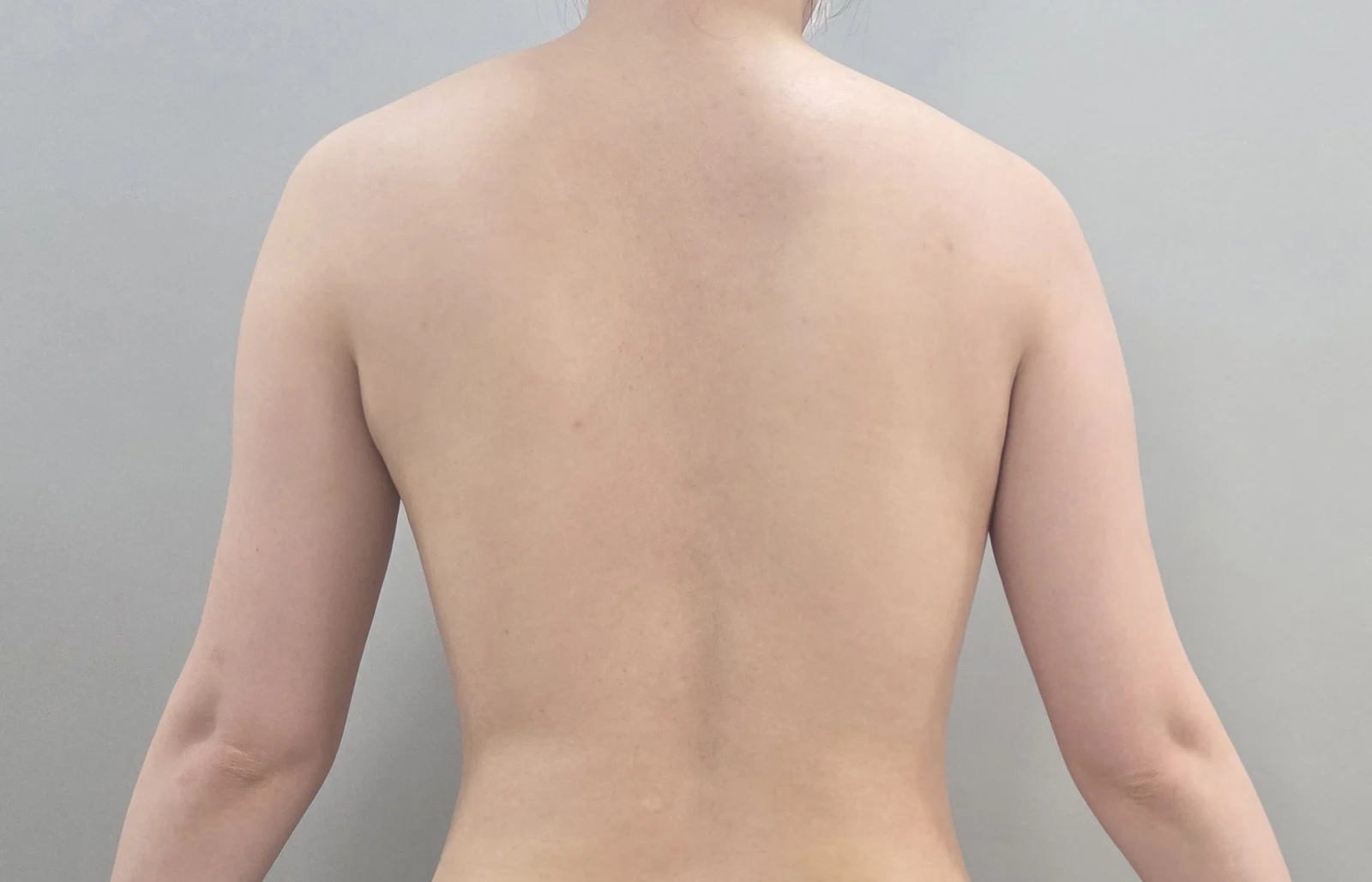 Exactly one month since my arm liposucti - Arm Liposuction Before 2 - TheLINE Plastic Surgery