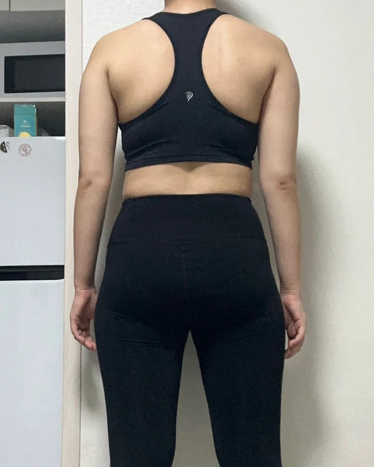 Arm lipo review!!! - Arm Liposuction Before 2 - TheLINE Plastic Surgery