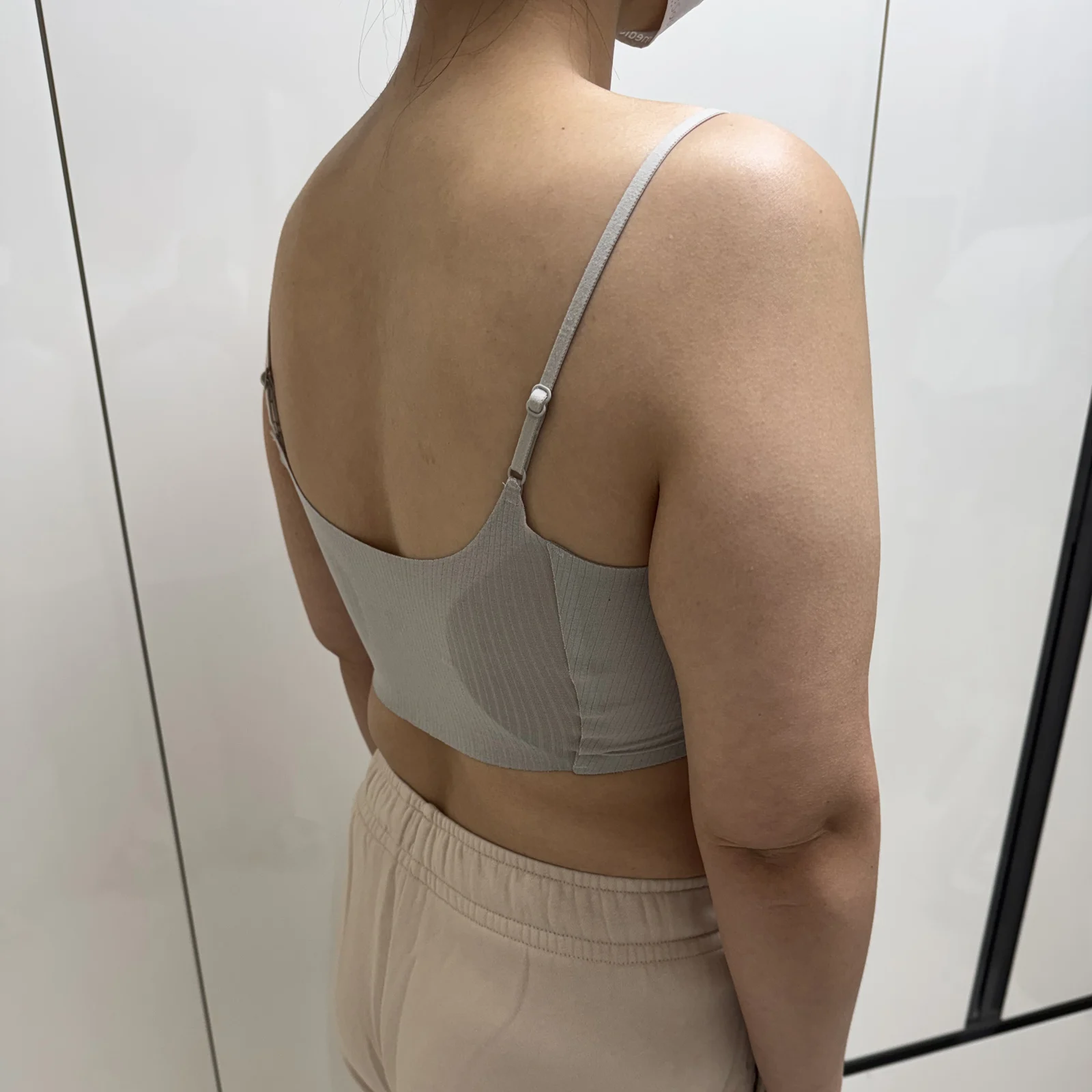 6-month review of arm lipo and arm lift - Body Contouring Before 2 - TheLINE Plastic Surgery