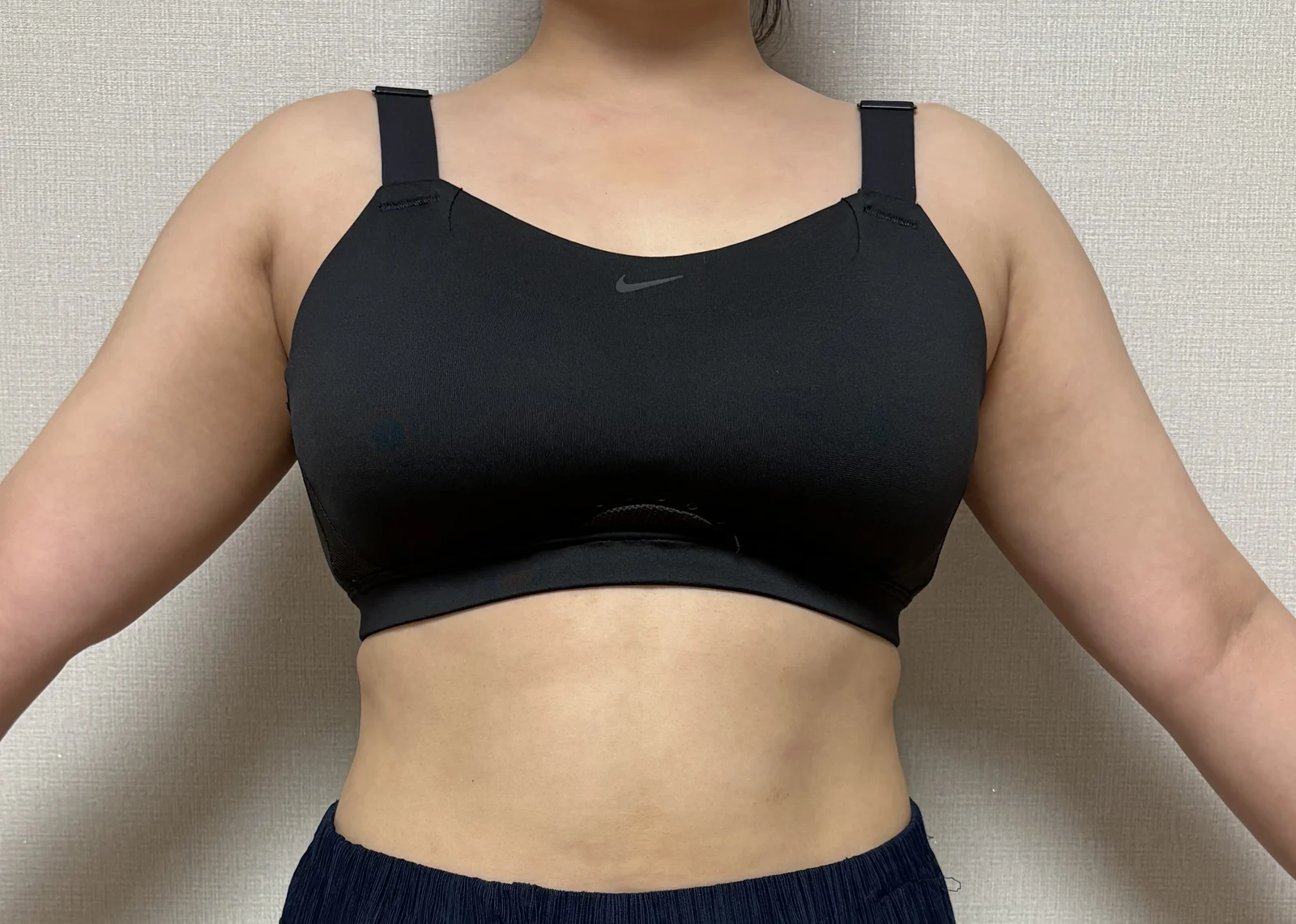 It's been 6 months since my arm liposuct - Arm Liposuction Before 2 - TheLINE Plastic Surgery