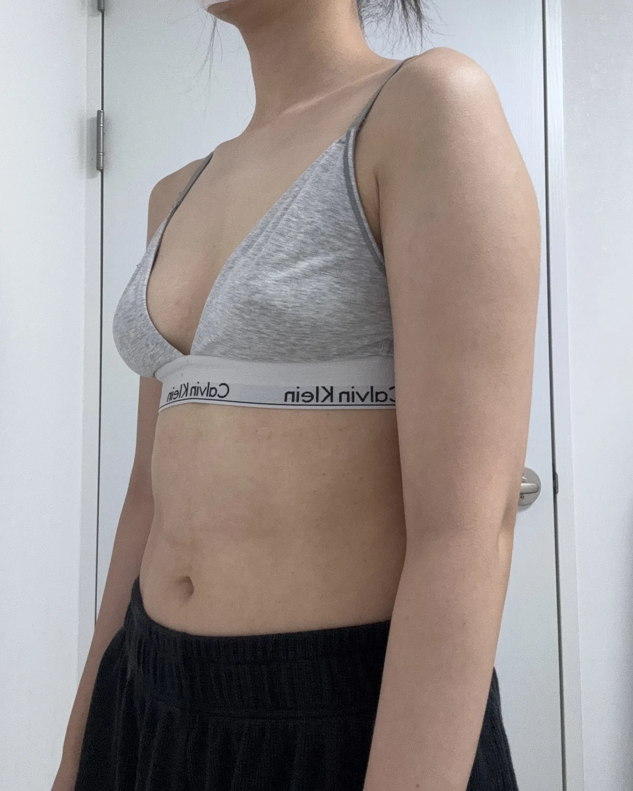 Three-month review of arm and accessory  - Arm Liposuction Before 2 - TheLINE Plastic Surgery