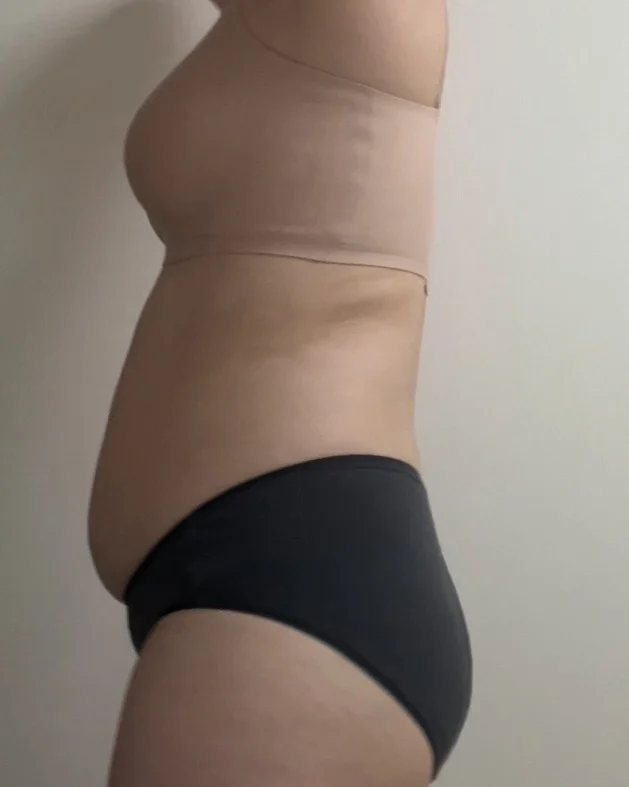 It's been 6 months since my abdominal li - Abdominal Liposuction (Upper Body) Before 2 - TheLINE Plastic Surgery