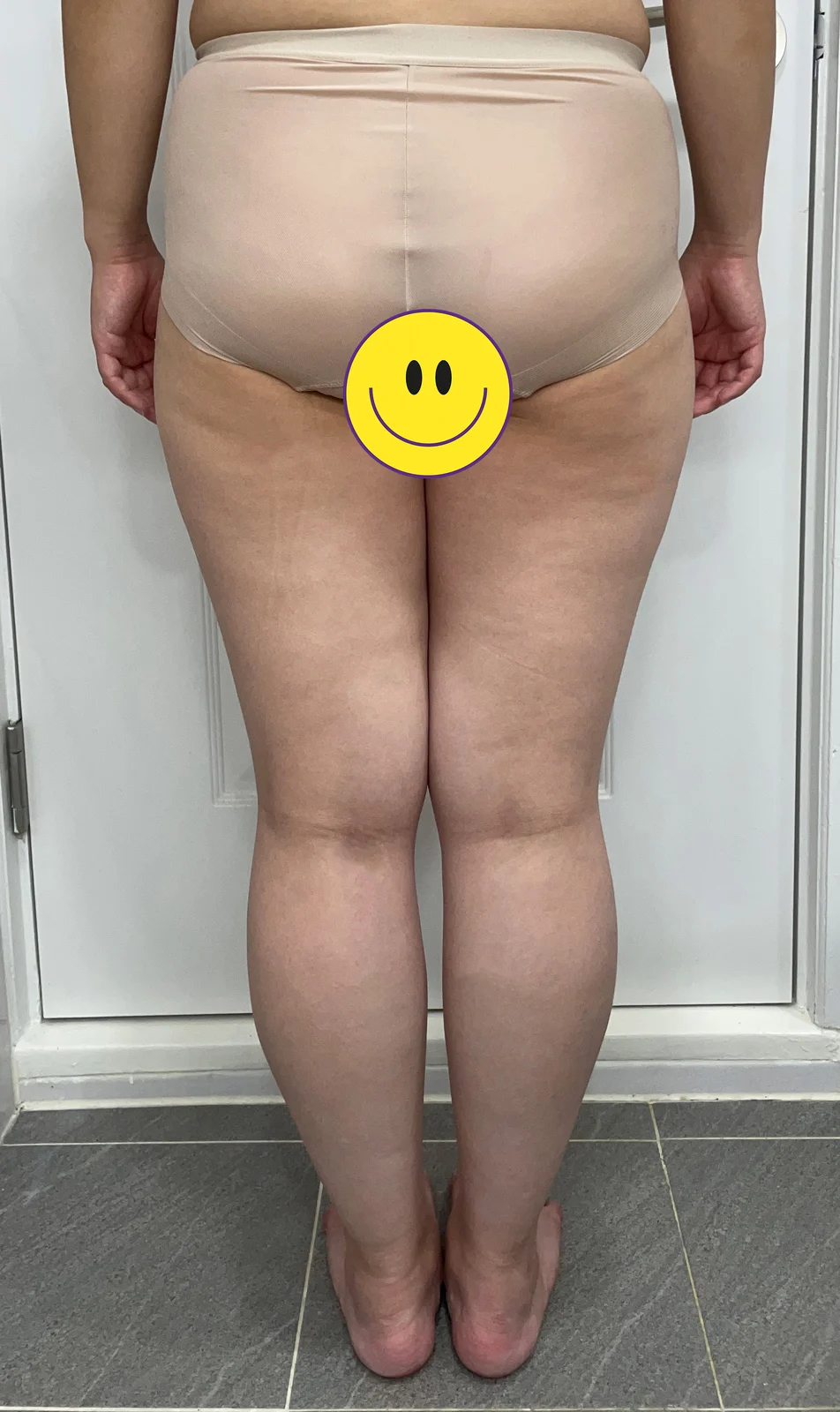 3 months after thigh and knee liposuctio - Thigh Liposuction (Lower Body) Before 2 - TheLINE Plastic Surgery
