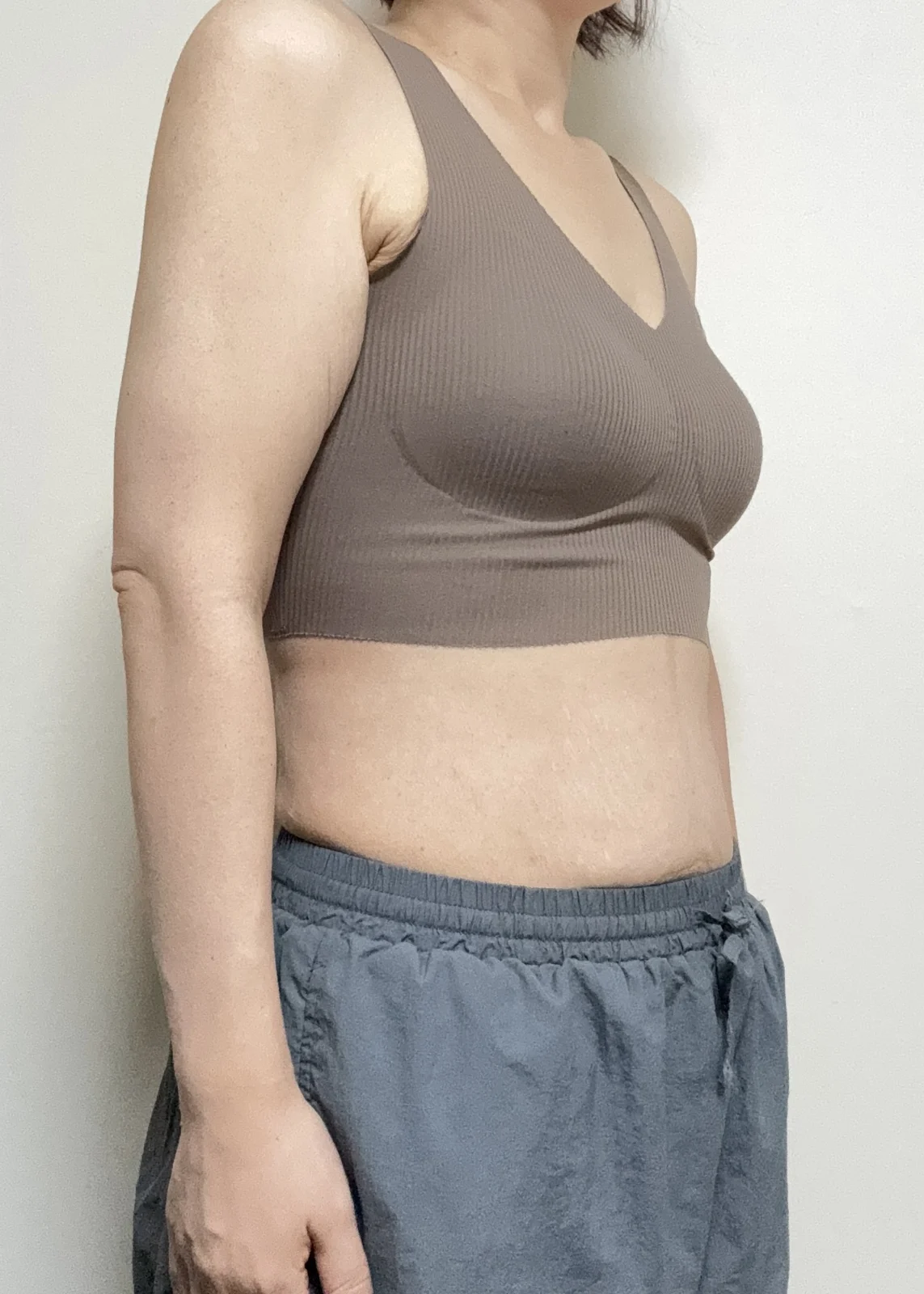 6 months after arm liposuction and an ar - Body Contouring Before 2 - TheLINE Plastic Surgery
