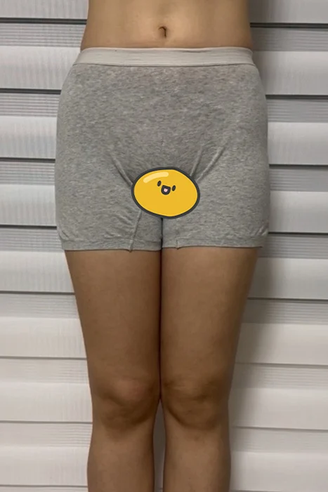 Thigh liposuction and hip fat grafting,  - Thigh Liposuction (Lower Body) Before 2 - TheLINE Plastic Surgery