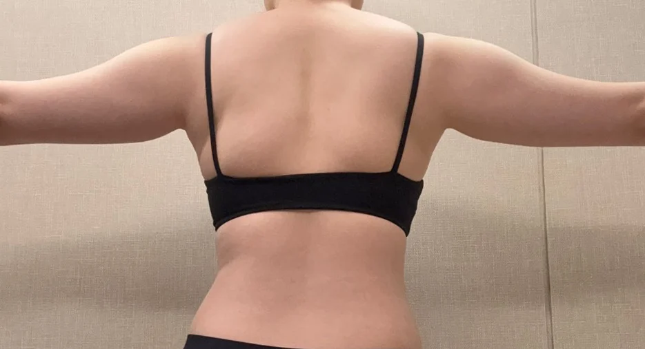 One month after arm liposuction! - Arm Liposuction Before 2 - TheLINE Plastic Surgery